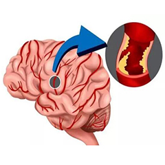 經(jīng)顱多普勒廠家告訴你15個(gè)腦中風(fēng)的誤區(qū)