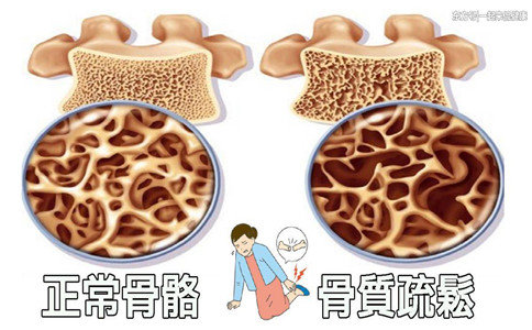 骨質疏松危害