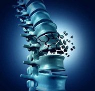 骨密度是一個嚴重的健康問題，不易察覺卻危害很大！