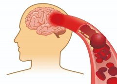 腦供血不足可檢查、可逆轉嗎